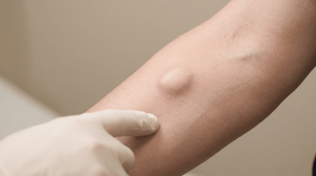 Close-up clinical photography showing soft subcutaneous lump beneath skin — lipoma or cyst assessment at Centre for Surgery London