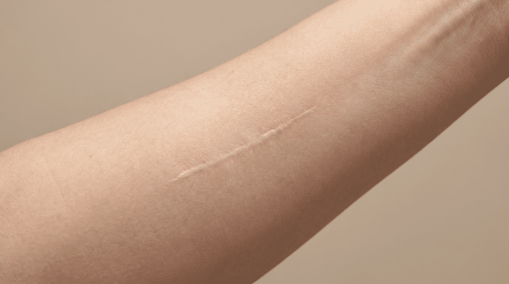 Close-up of healed skin showing a fine pale mole removal scar — Centre for Surgery London