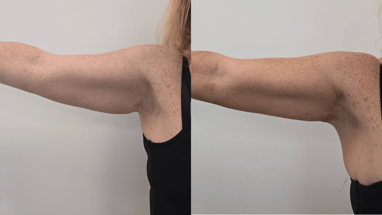 mini arm lift before and after