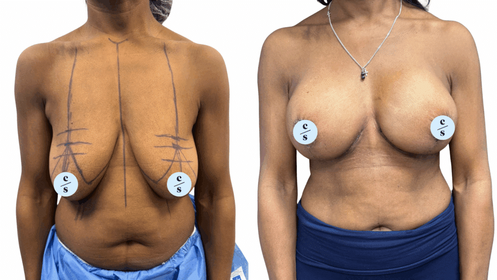augmentation mastopexy (implant and lift)