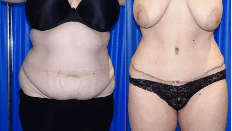 brazilian abdominoplasty before and after